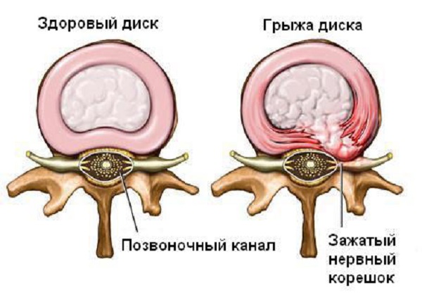 Грыжа4_600_419.jpg